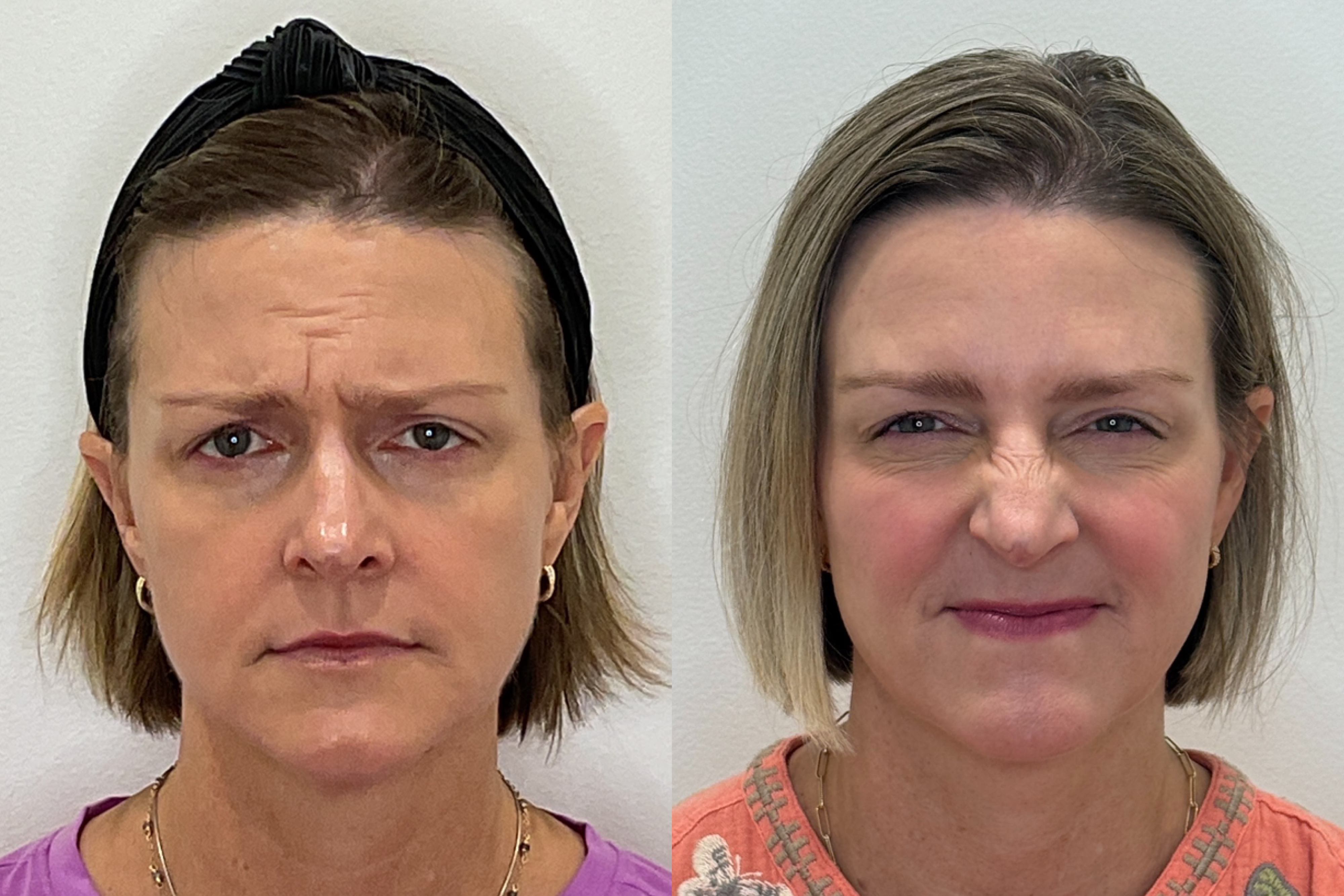 Before and after showing smooth skin with natural expression capability