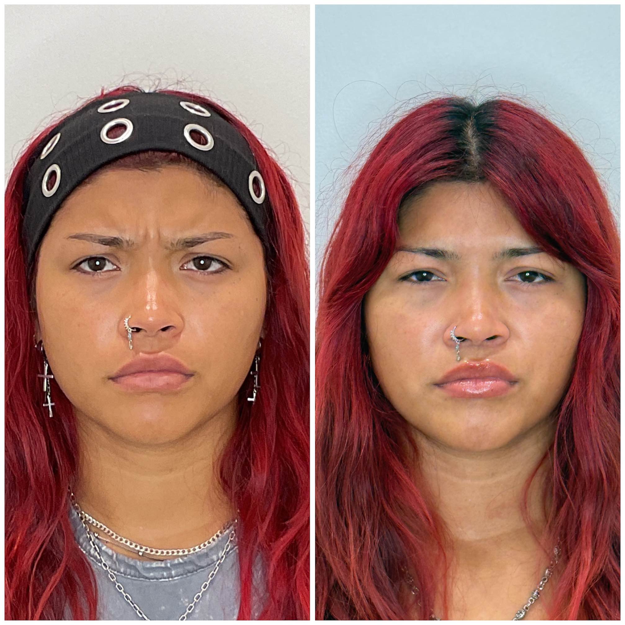 Natural frown line results