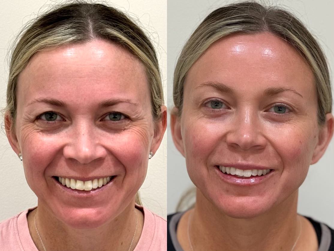 Natural crow's feet results