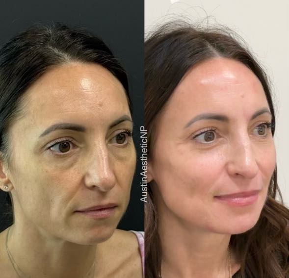 Facial harmony improvements multiple angles 5