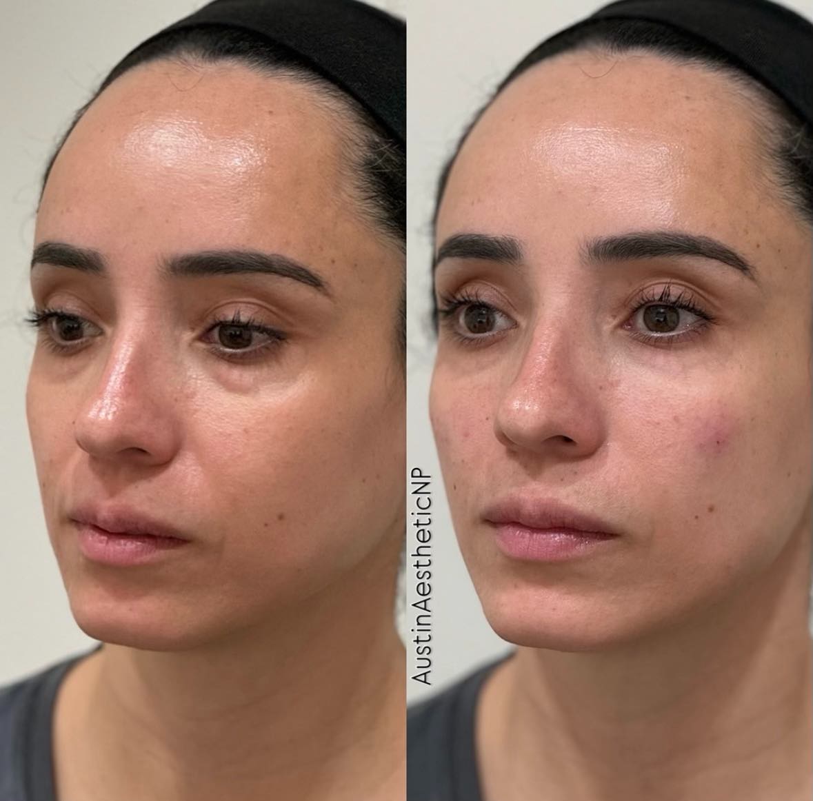 Facial harmony improvements multiple angles 2