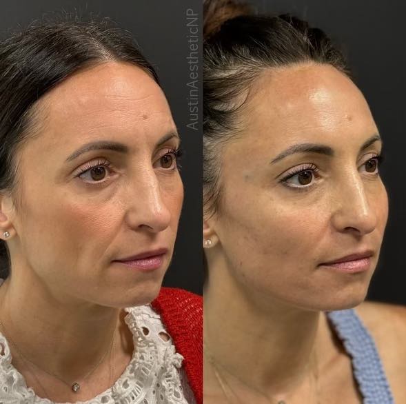 Facial harmony improvements multiple angles 3