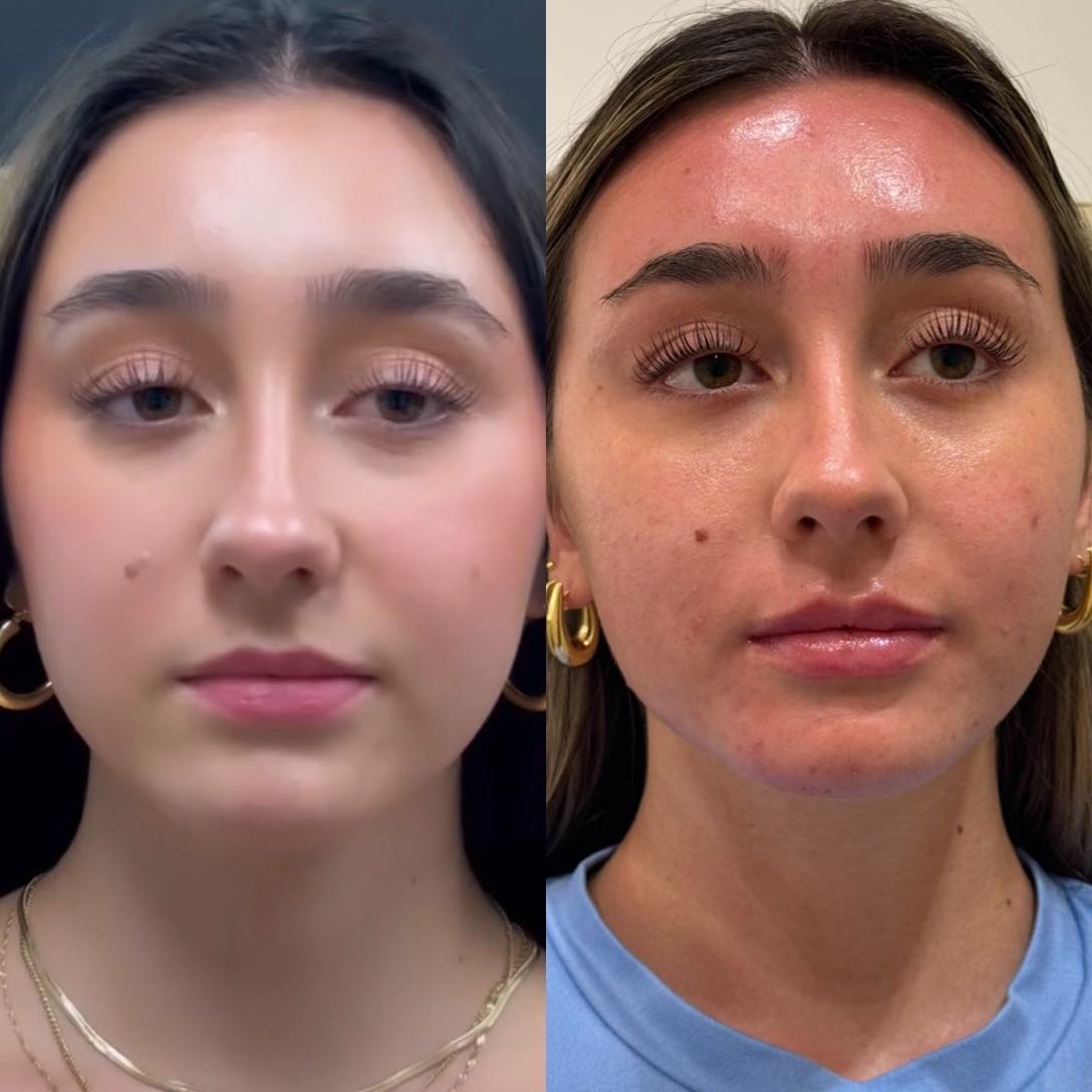 Lip filler before and after results 1