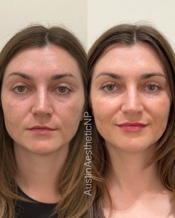 Lip filler before and after results 2