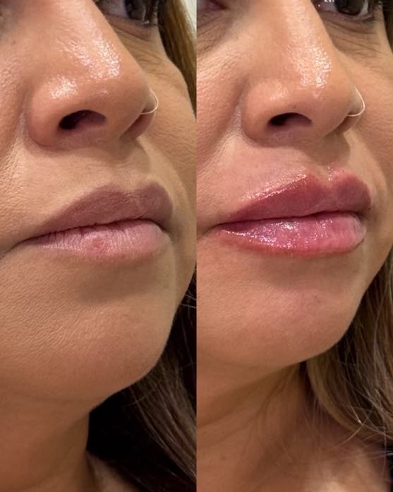 Before and after lip filler showing significant volume increase with beautiful shape