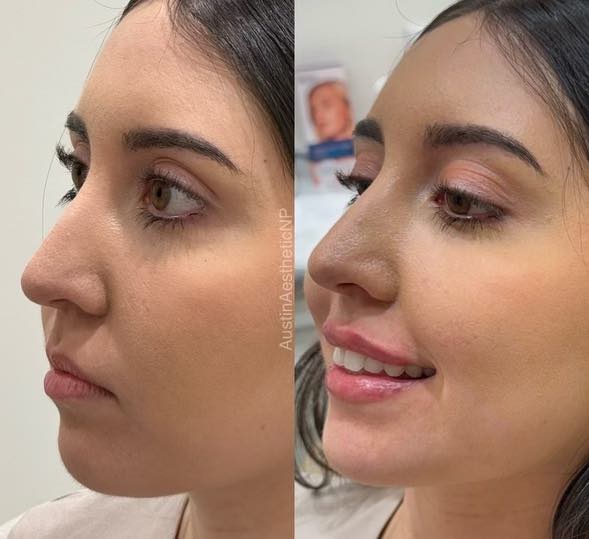 Lip filler before and after results 4