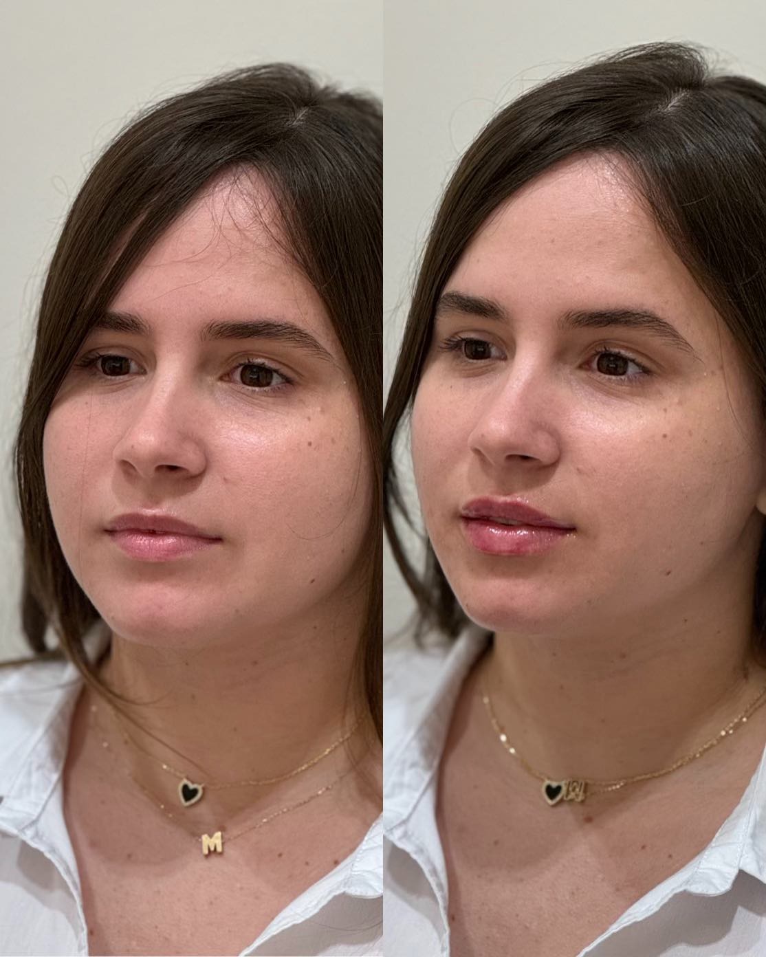 Lip filler before and after results 5