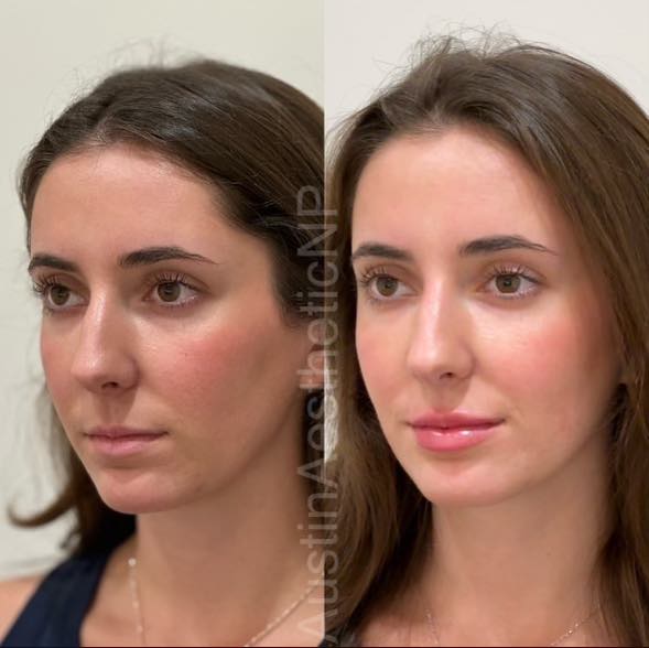 Lip filler before and after results 6