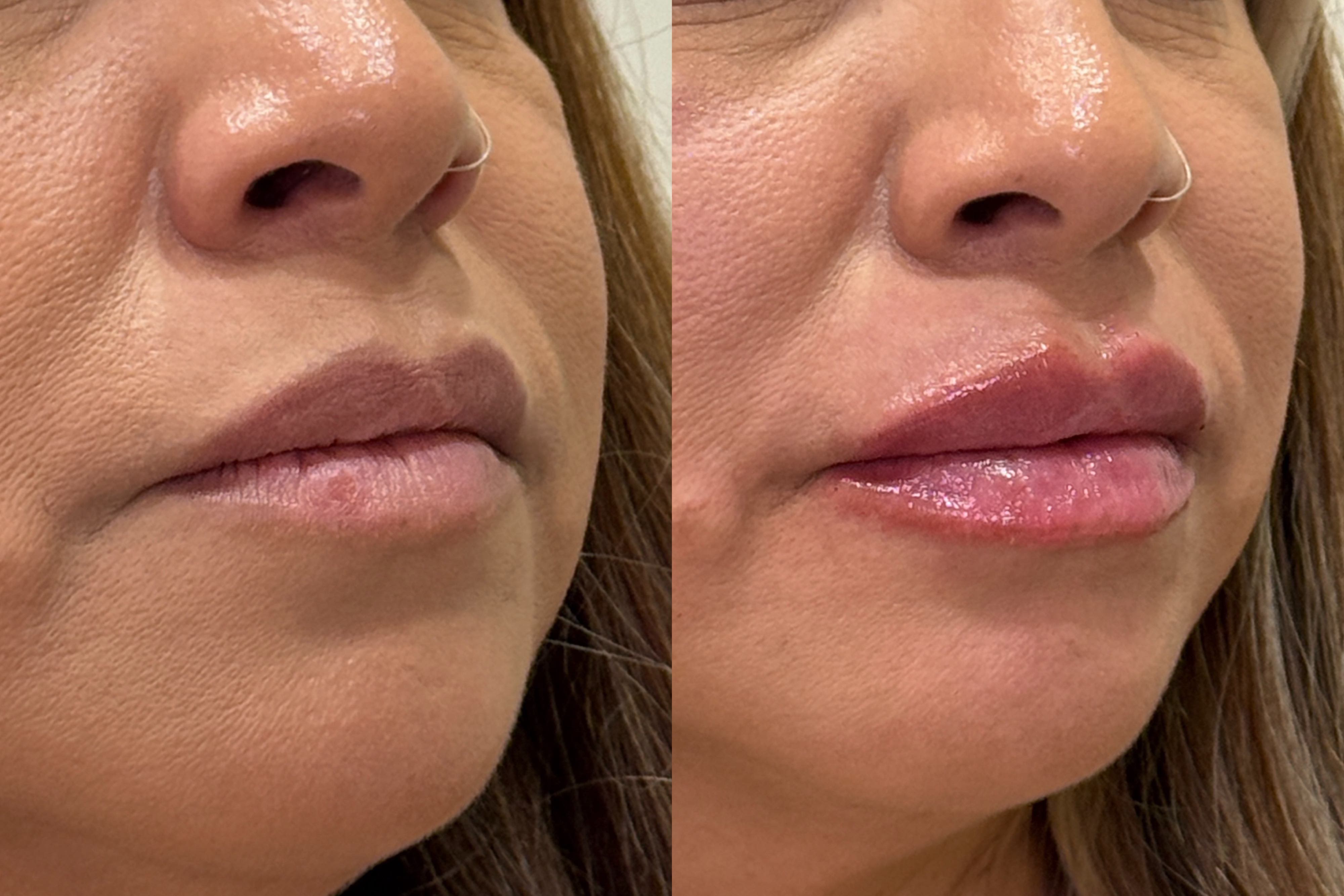 Lip filler and natural results