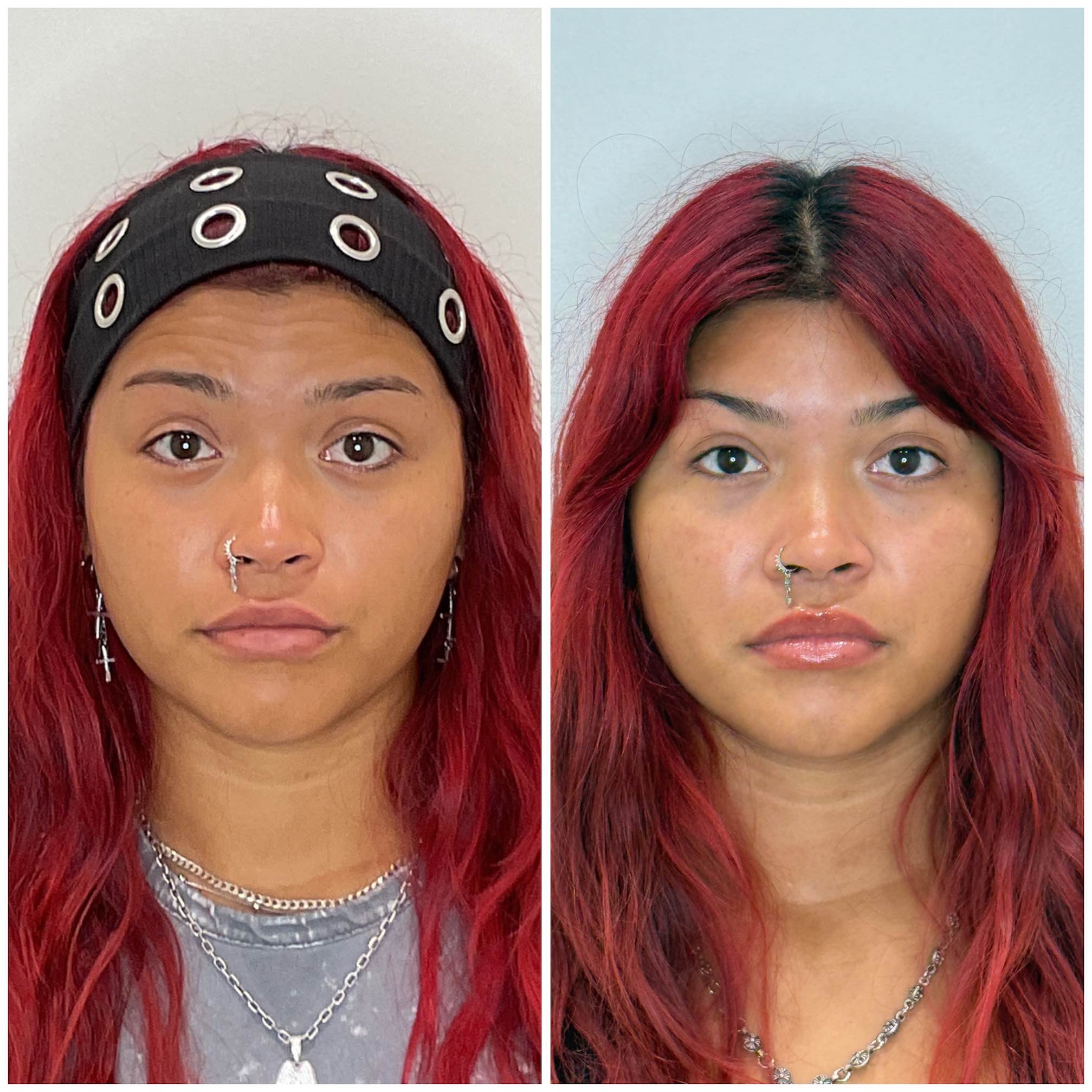 Injector marking injection points on patient's face