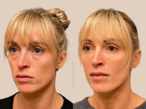 Before and after photo of a patient who received tear trough filler treatment at Austin Aesthetic Atelier, highlighting reduced under-eye hollows and a rejuvenated appearance.