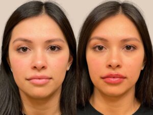 Before and after photo of a patient who received lip filler treatment at Austin Aesthetic Atelier, showing enhanced lip volume and symmetry.