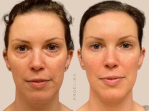 Before and after photo of a patient who received tear trough filler treatment at Austin Aesthetic Atelier, showcasing reduced under-eye hollows, eyelid bags and a refreshed, youthful appearance.
