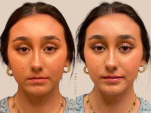 Before and after photo of a patient who received lip filler treatment at Austin Aesthetic Atelier, highlighting enhanced lip volume and natural symmetry.