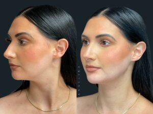 Before and after photo of a patient who received jawline filler treatment at Austin Aesthetic Atelier, showcasing enhanced jawline definition and contour.