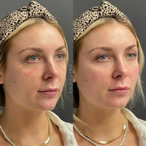 Before and after photo of a patient who received tear trough filler treatment at Austin Aesthetic Atelier, showcasing reduced under-eye hollows and a refreshed appearance.
