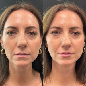 Before and after photo of a patient who received lip filler treatment at Austin Aesthetic Atelier, showcasing enhanced lip fullness and natural balance.