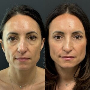 Before and after photo of a patient who underwent full facial balancing with Sculptra filler and wrinkle relaxers at Austin Aesthetic Atelier, showcasing enhanced facial symmetry and rejuvenation.