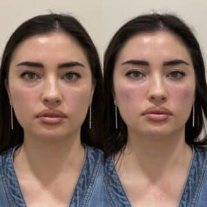 Before and after images of a dermal filler treatment showing enhanced facial contours and a rejuvenated, balanced appearance