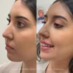 Side-by-side before and after of a female patient showcasing subtle, natural-looking lip filler enhancement at Aesthetic Atelier in Austin, Texas.