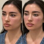 Before and after results of a female patient who received cheek and lip dermal fillers at Austin Aesthetic Atelier, showcasing enhanced volume and definition.