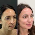 Before and after photo of a female patient treated with dermal fillers at Austin Aesthetic Atelier, highlighting improved cheek volume and smoother smile lines.
