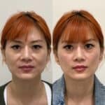 Before and after image of a female patient who received under-eye and midface dermal filler at Austin Aesthetic Atelier, showing brighter eyes and improved facial volume.